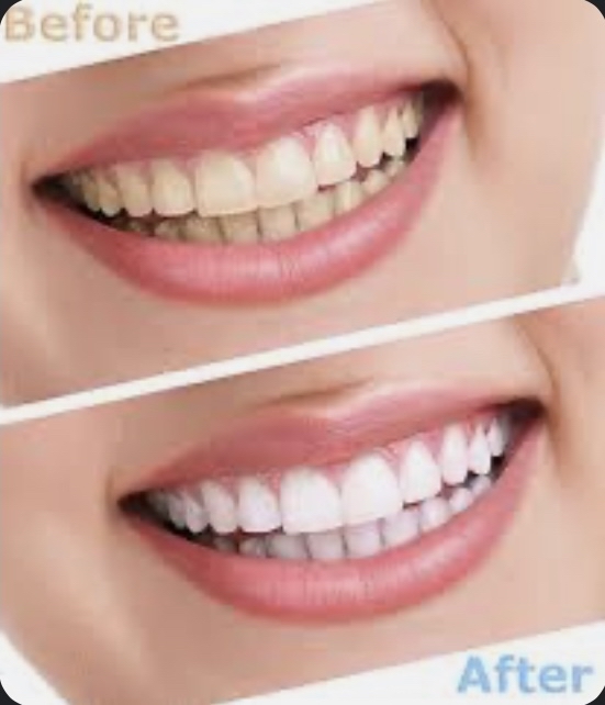 Teeth  Whitening