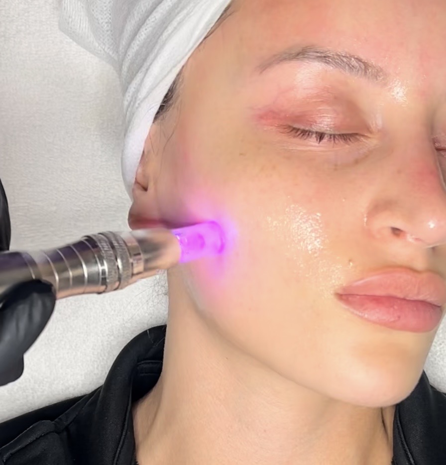 Microneedling Facial at Pure Elegance Esthetics in North Andover, MA