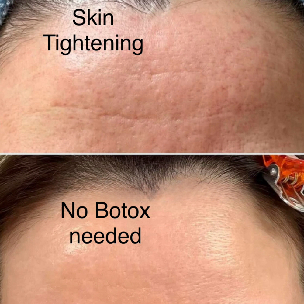 Inkless Wrinkle Treatment at Flawless Skin By Sarah in Roseville, CA