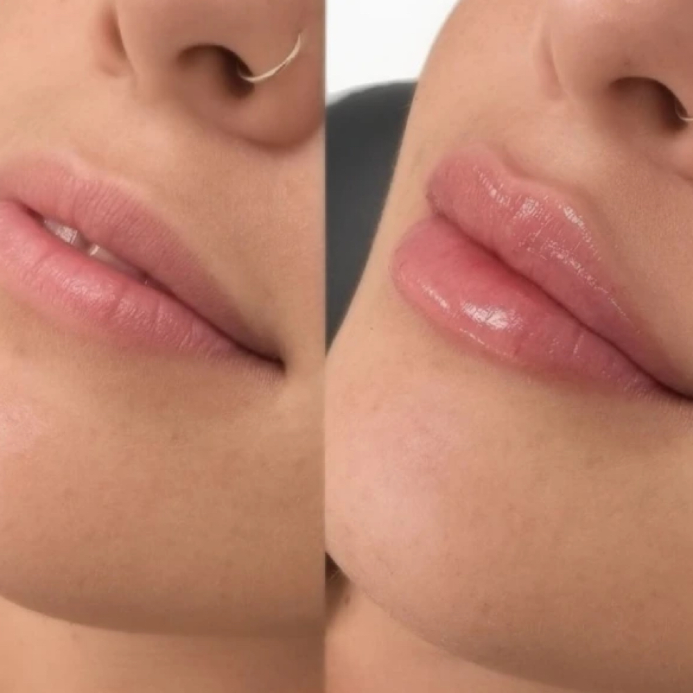 Full Syringe Lip Filler