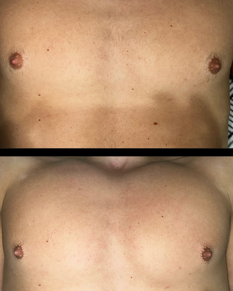 Chest Wax