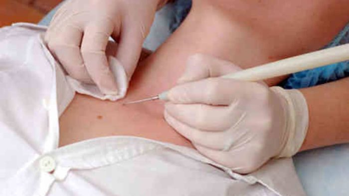 Sking Tag Removal Starts at