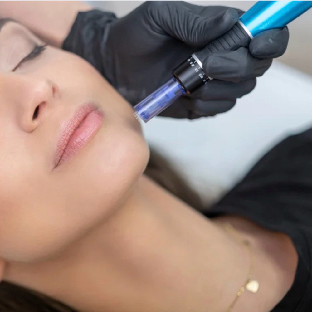 Nano-Needle Infusion Treatment at Esthetically Yours, Erica in Claremont, CA