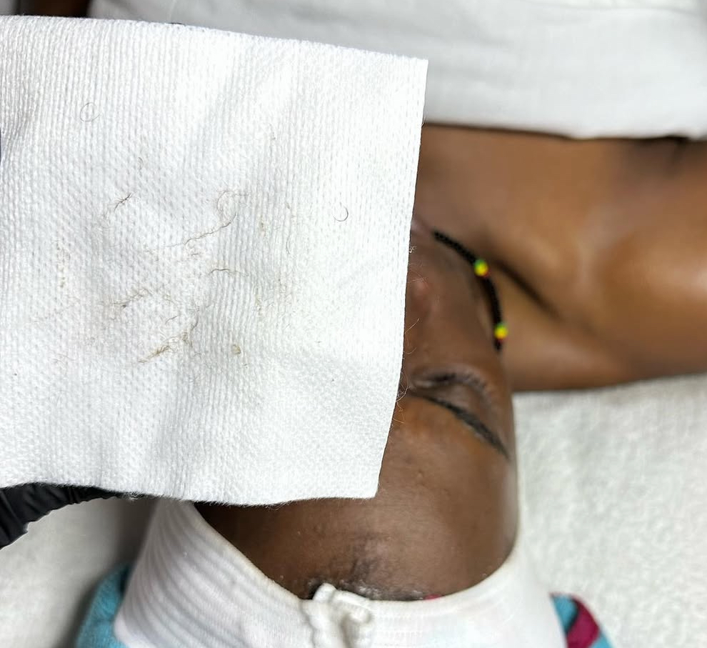 Dermaplane Facial