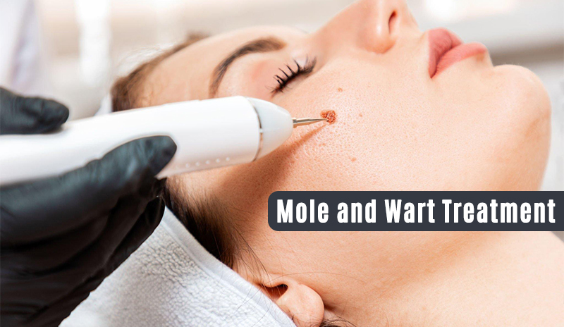 Mole and Warts Removal