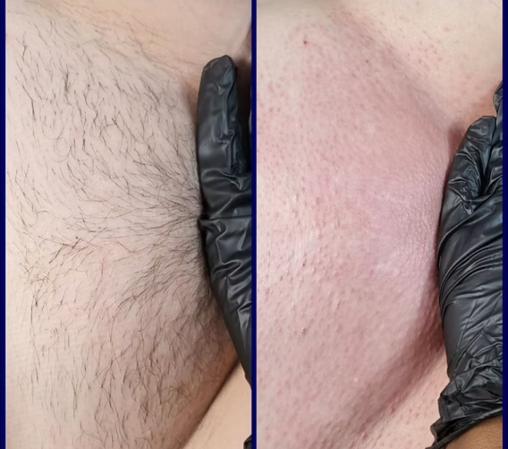 Brazilian Wax