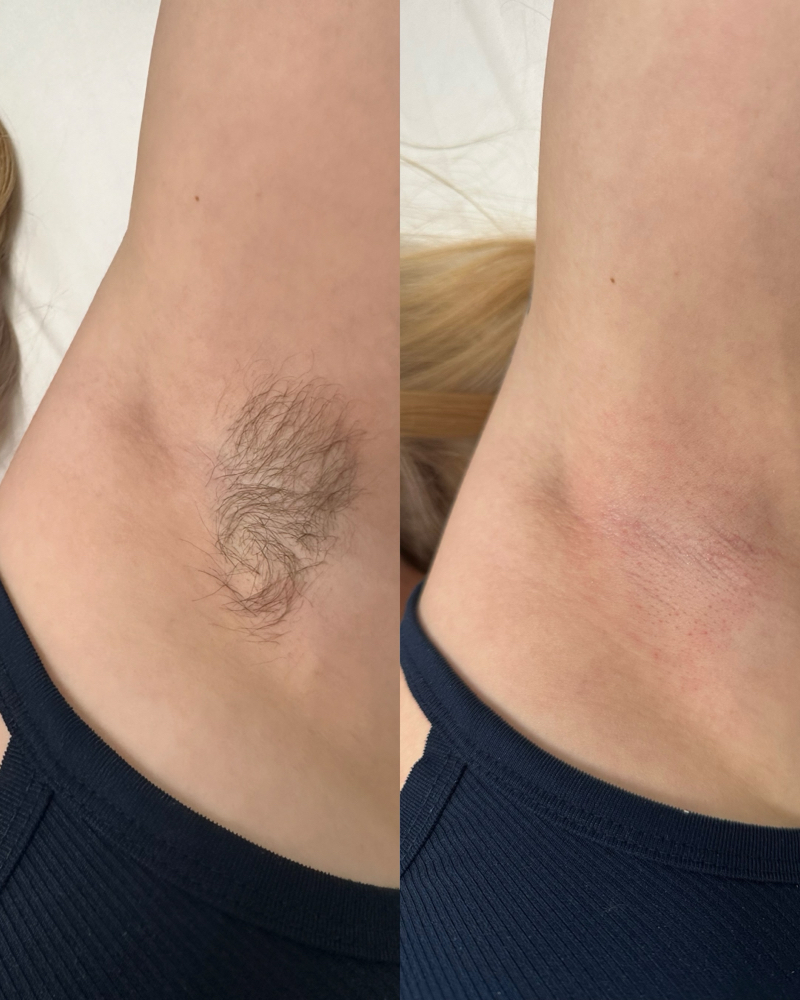 Underarm Wax