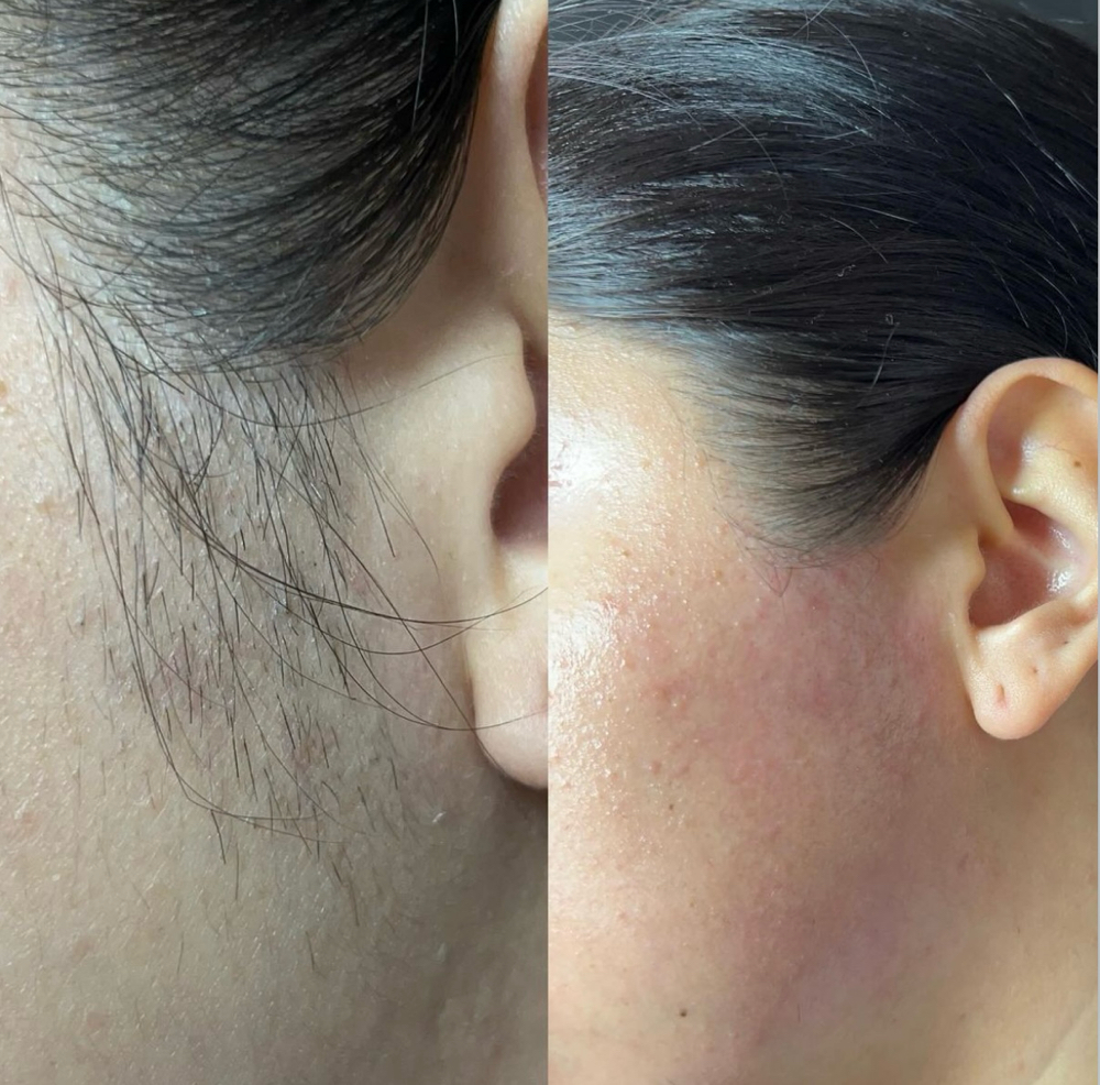 Depilacion Patillas