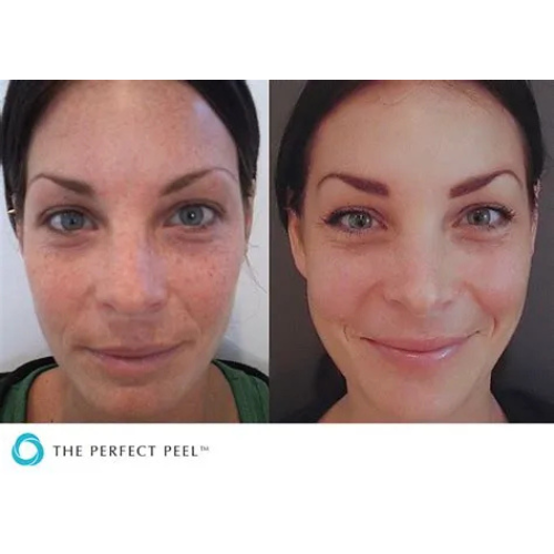 THE PERFECT DERMAPEEL