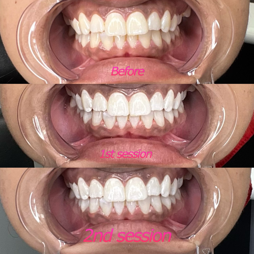 2 Sessions at Too Flawless Esthetics in Memphis, TN