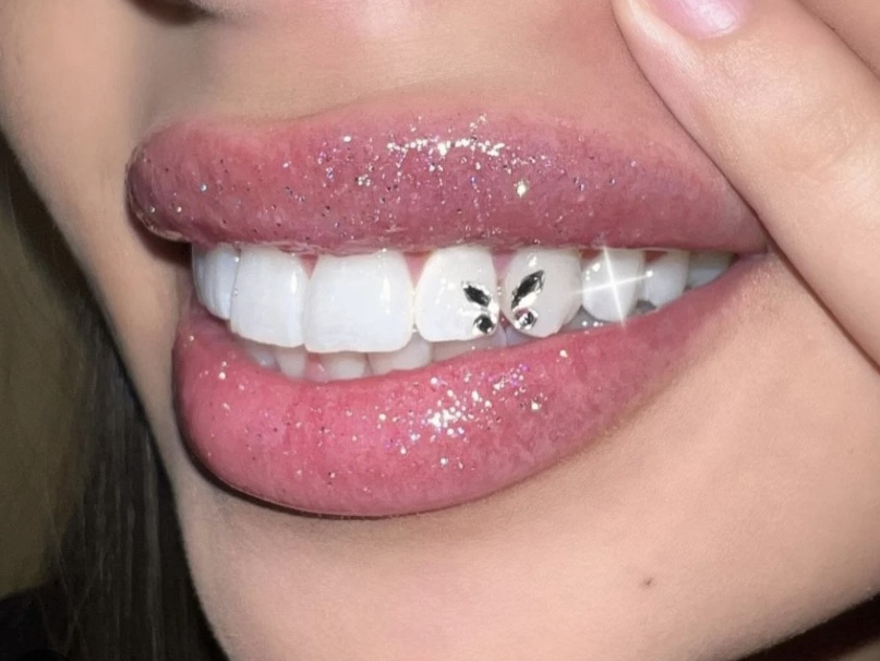 40 Min Teeth Whitening + Butterfly