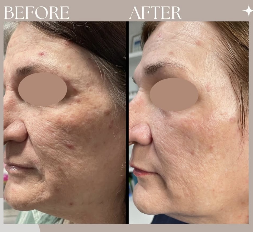 Microneedling with exosomes