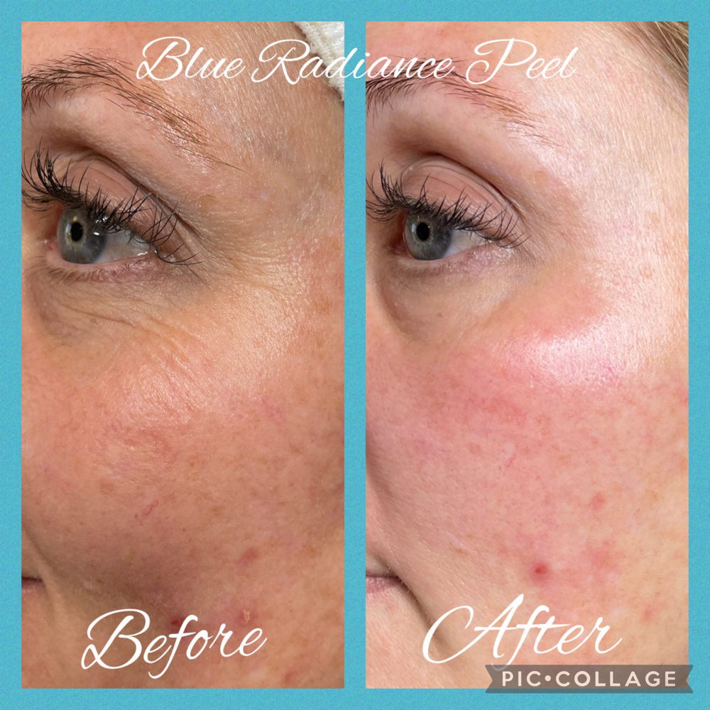 Blue Radiance Peel & Basic Facial