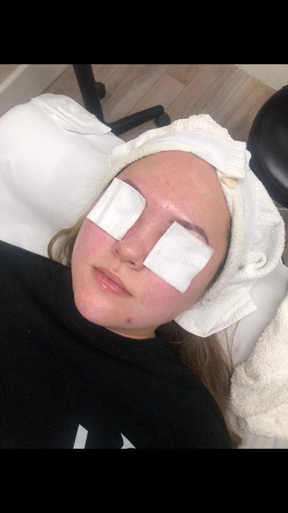 Microdermabrasion Facial