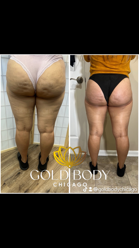 Cellulite Reduction 360