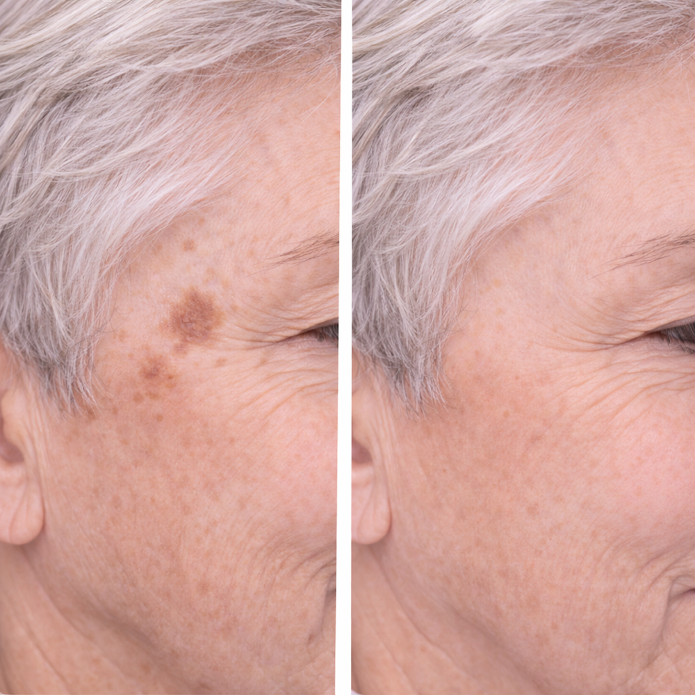 Pigment Removal - Small Area