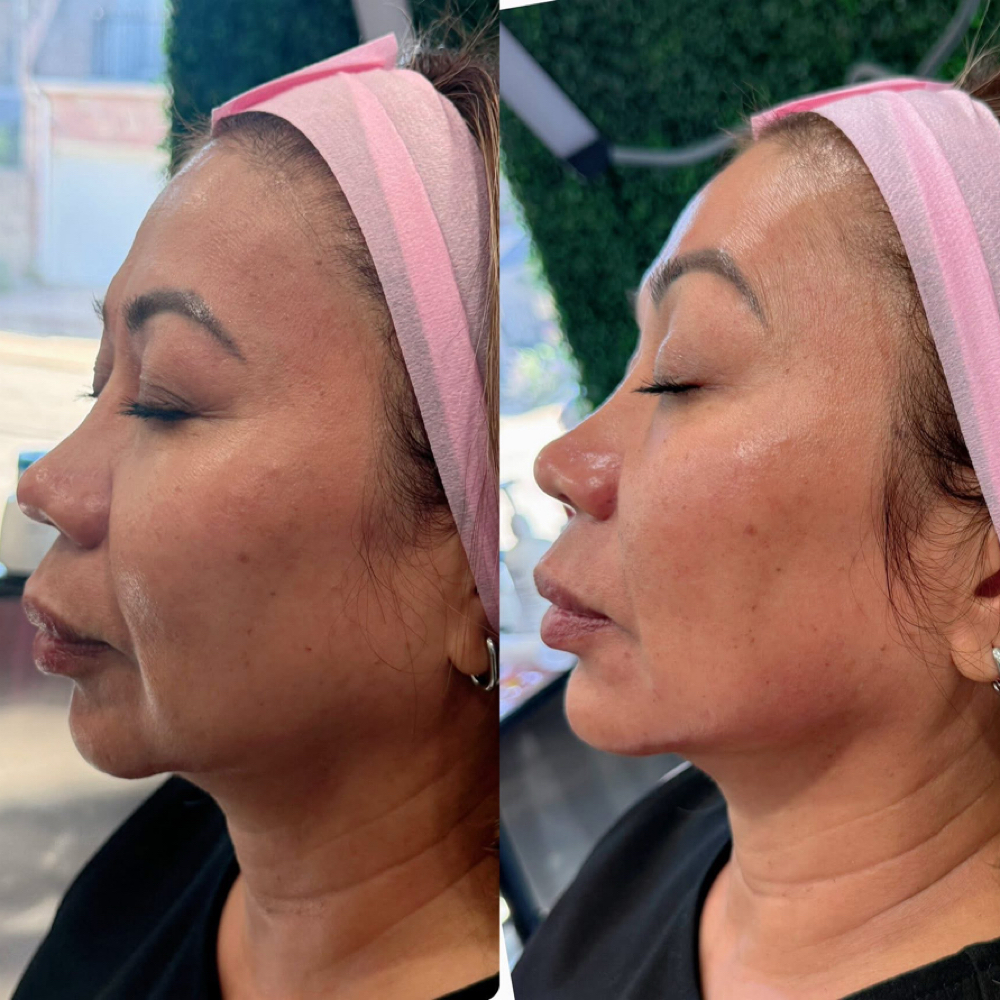 Cheek Filler at The Filler Lounge in Cypress, TX