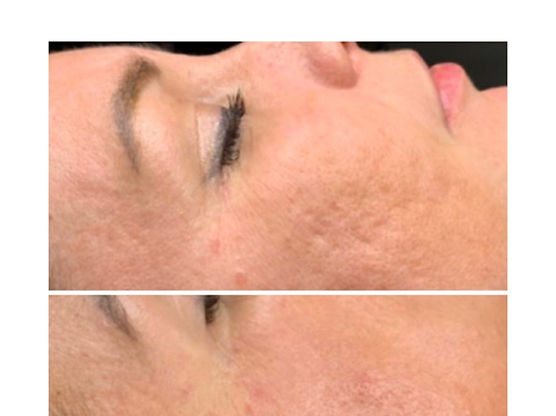 Microneedling Skin Rejuvination