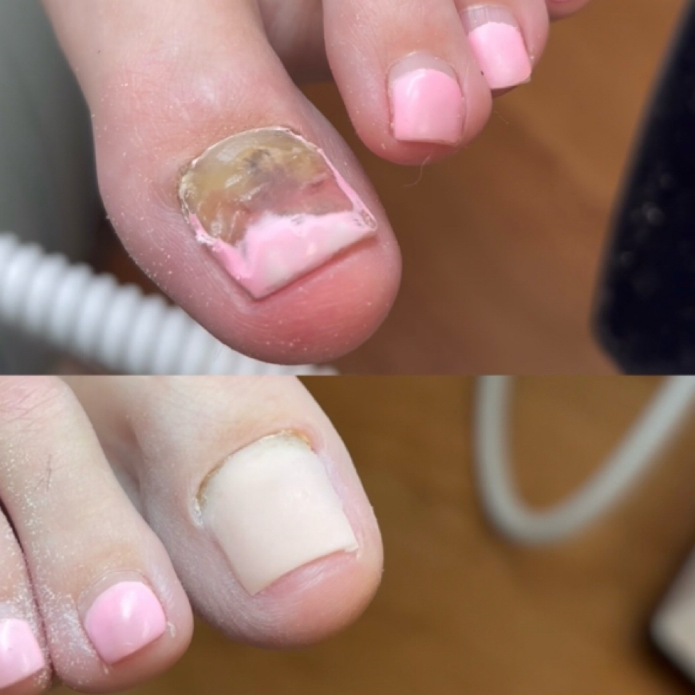 Toenail Reconstruction A La Cart at Jubilee Nails in San Antonio, TX