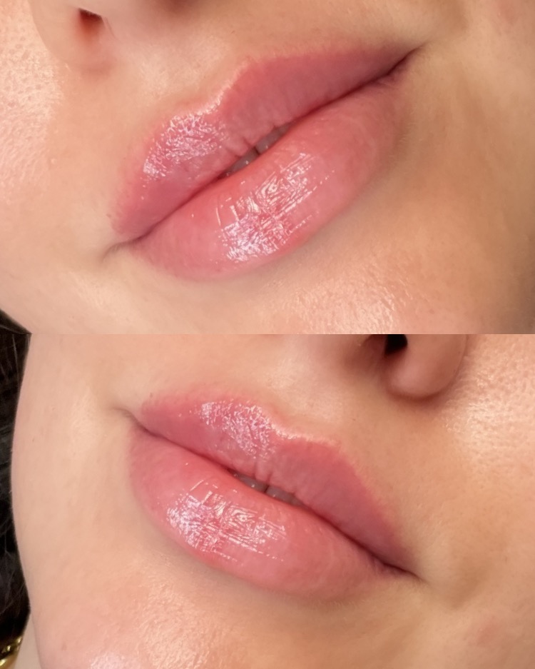 Lip Filler Follow Up