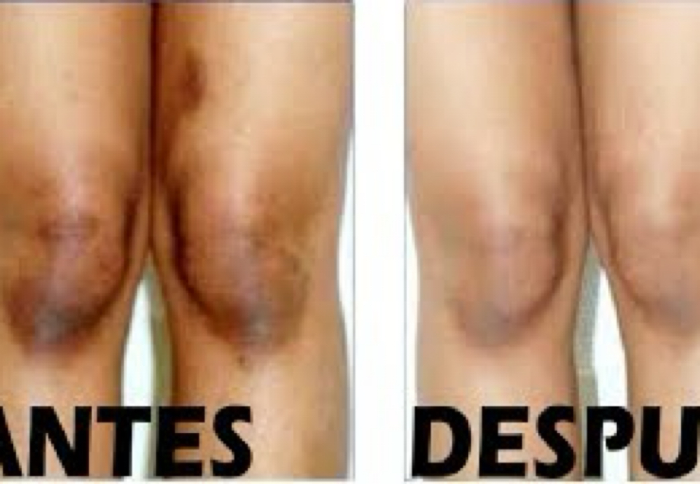 Knees at Leidy Cornelio Spa in Aurora, CO