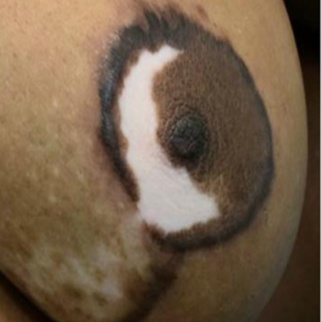Areola Repigmentation at Cosmetic Studio 54 in Los Angeles, CA