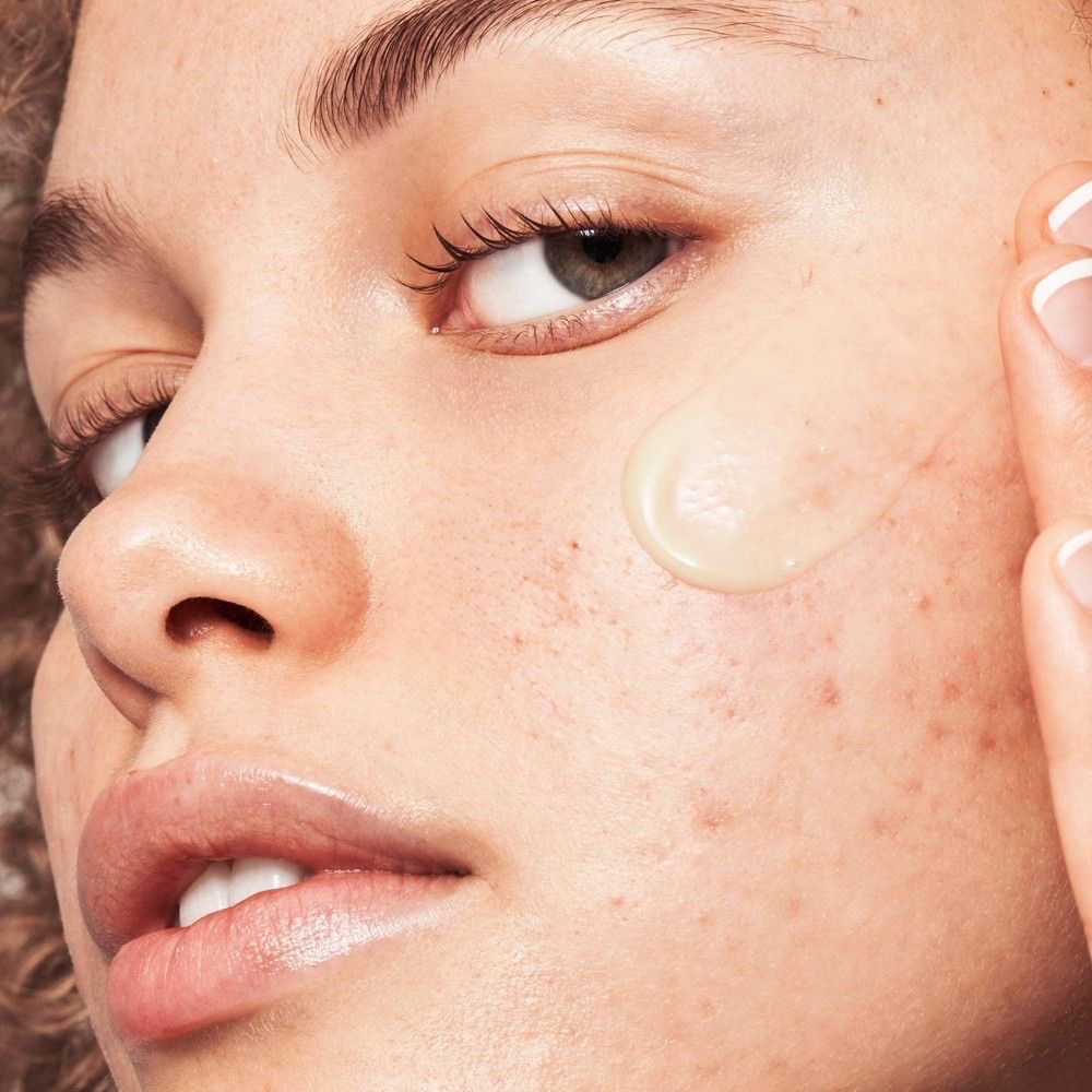 Acne Fighting Facial