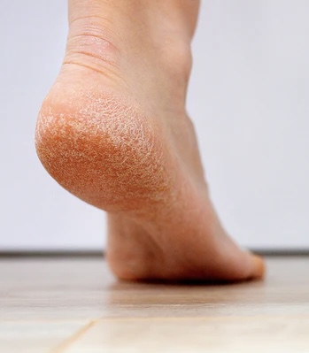 Sole Relief Dryness + Callus Care