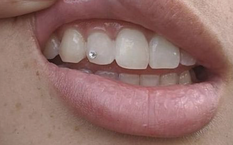 Single Tooth Gem