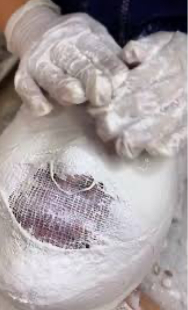 Facial Remodeling (Yesotherapy)