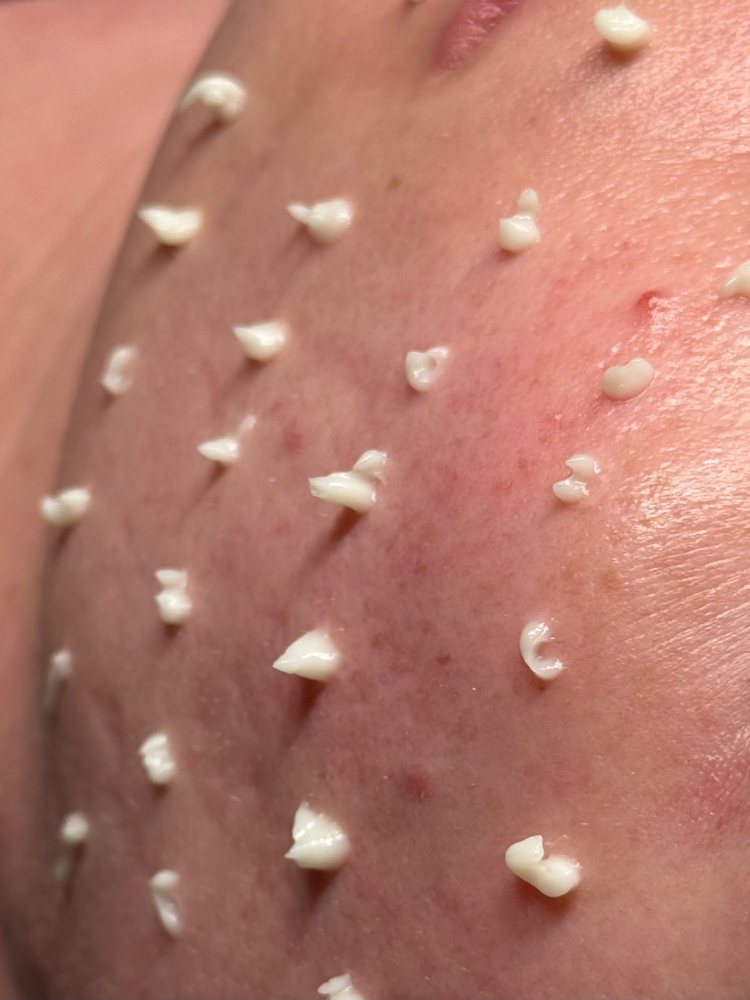 the liquid microneedling treatment at Butler Skin in Sheridan, WY