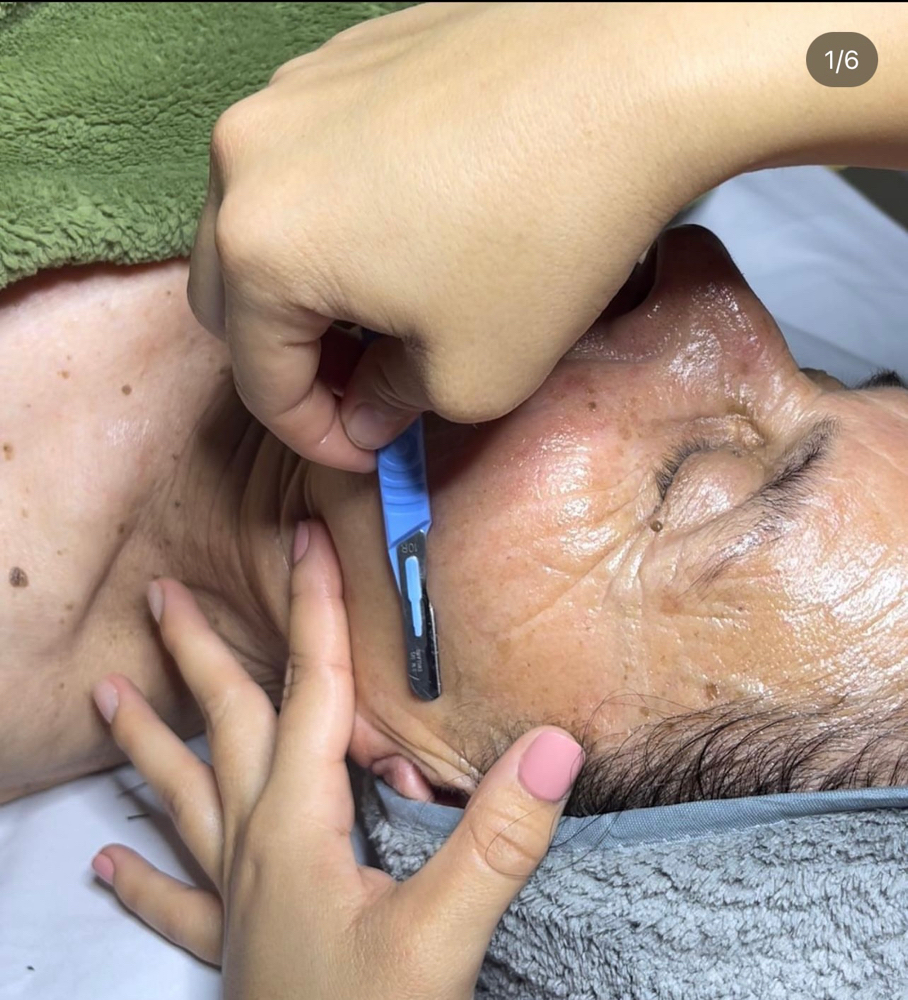 Dermaplaning