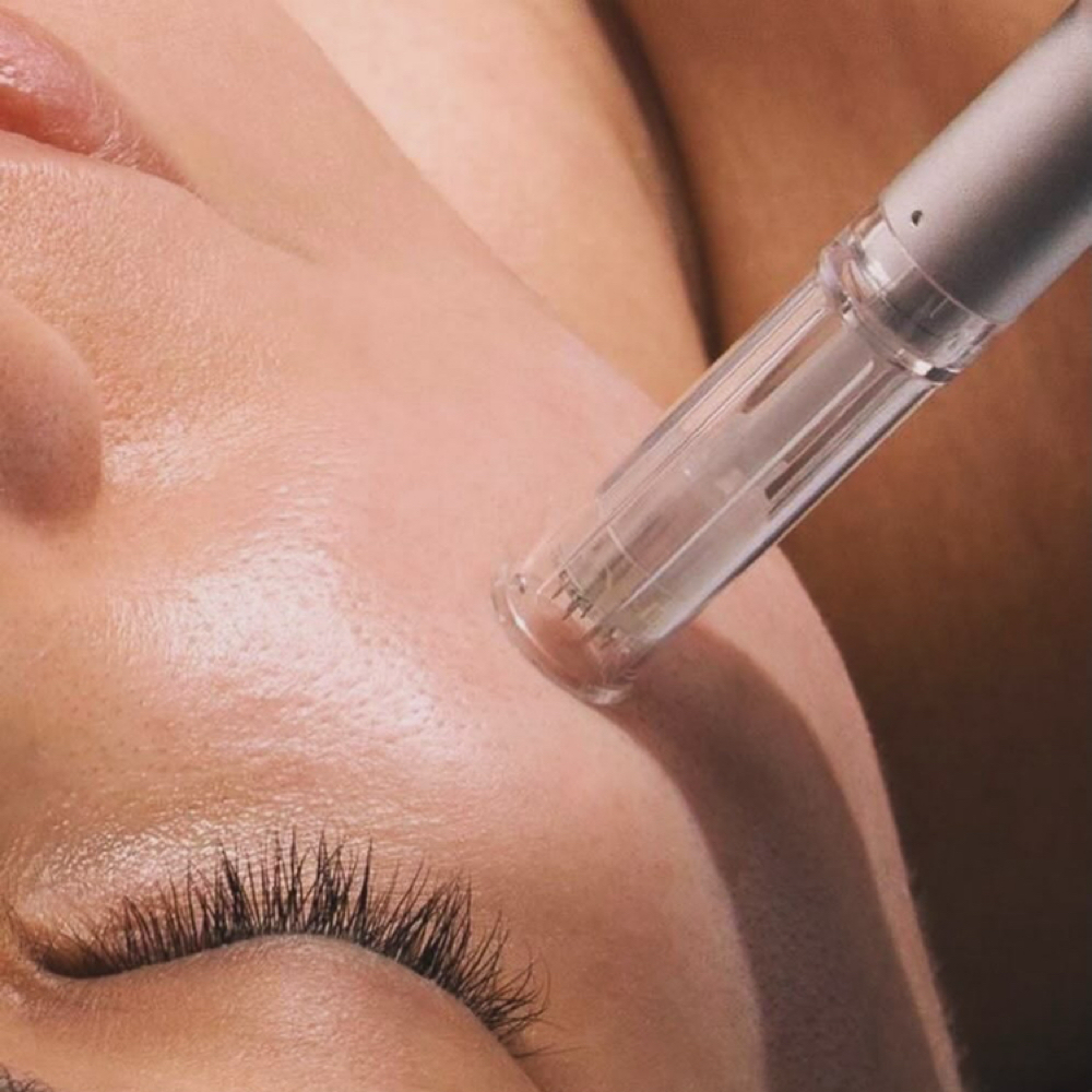 Microneedling at Sharon Nicole Aesthetics in Patchogue, NY