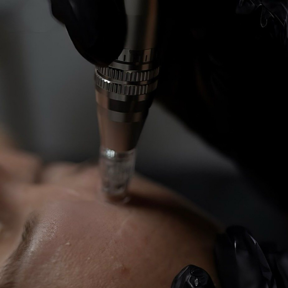 Microneedling at Sharon Nicole Aesthetics in Patchogue, NY