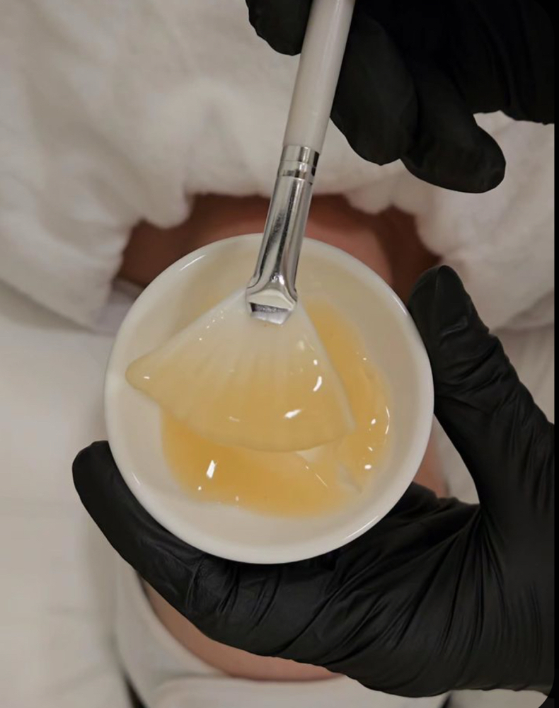 ‘Just’ Chemical Peel