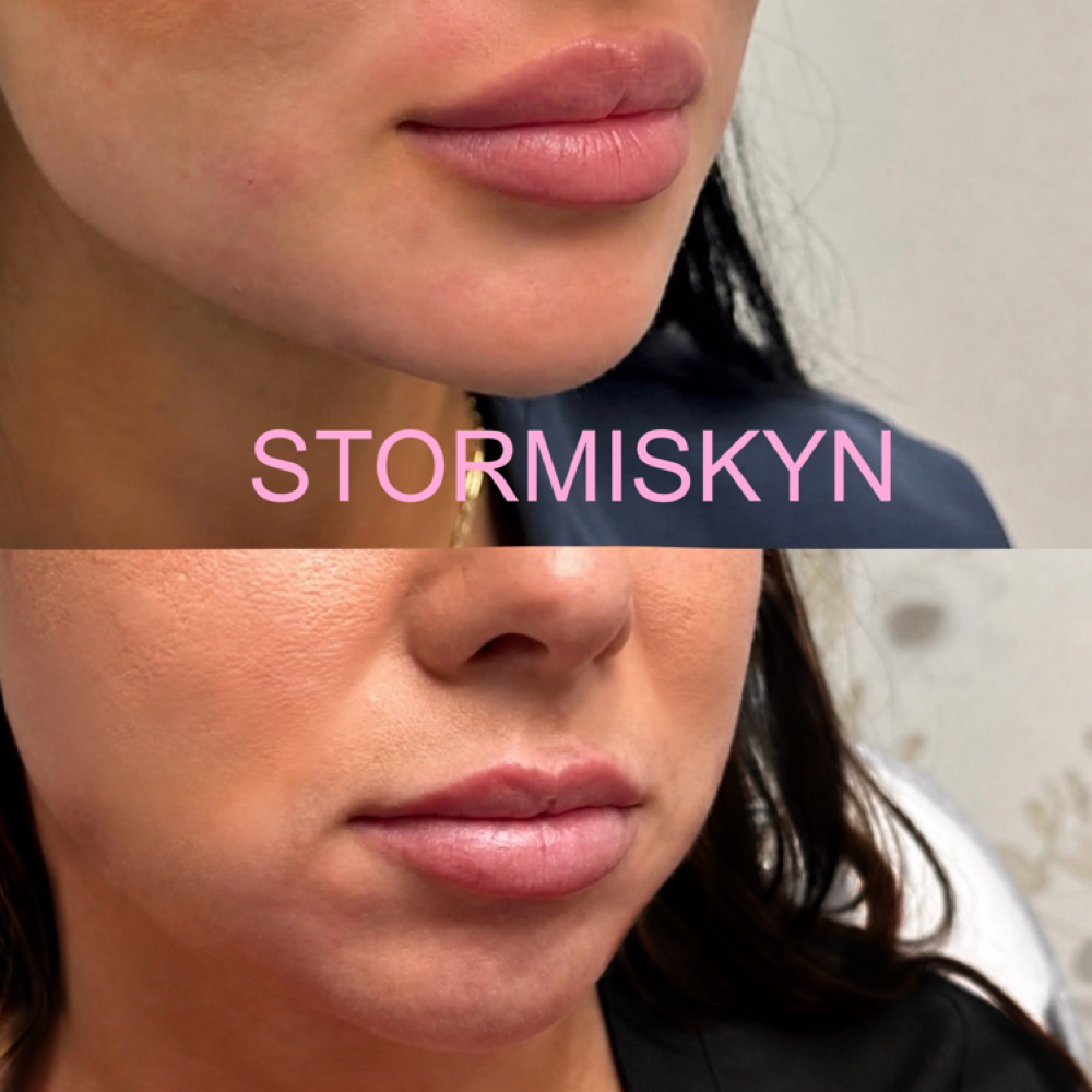 Facial Balancing at STORMI SKYN in Lubbock, TX