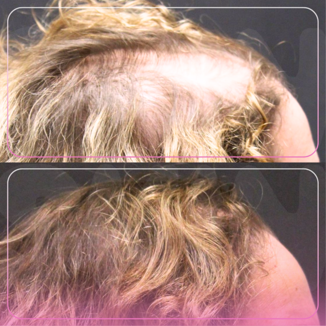 Hair Restoration- 5 Treatments