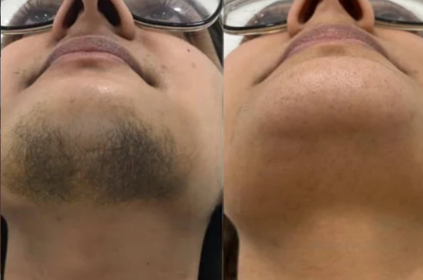 Chin Wax