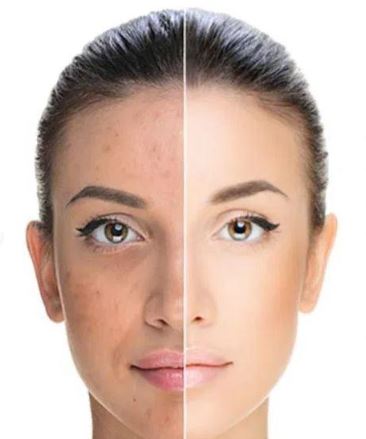 Chemical Peels