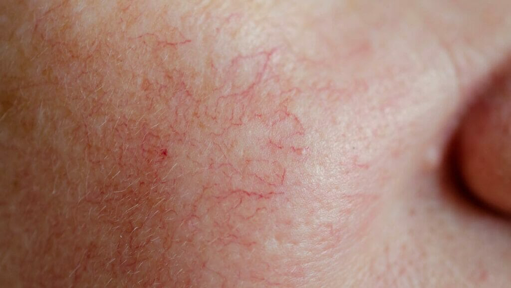 Laser Veins Treatment