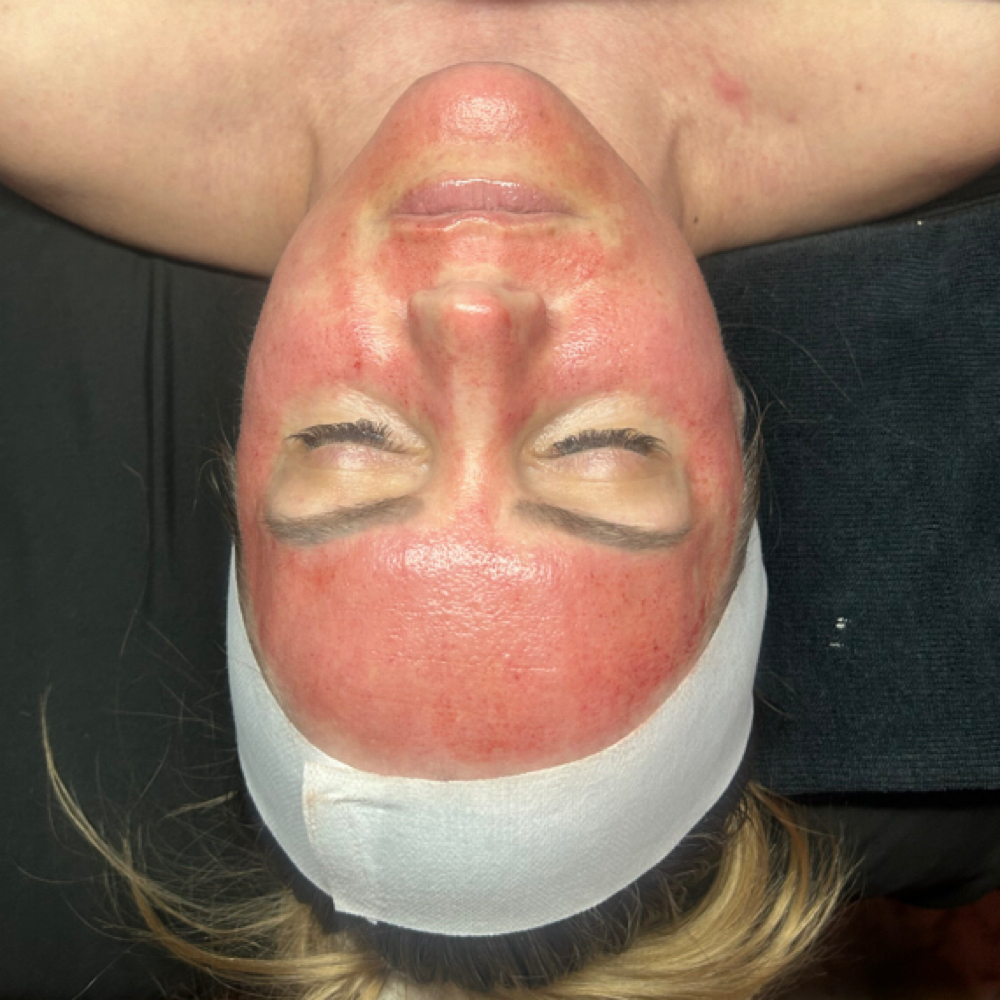 Microneedling at Lexibelleskin in St George, UT