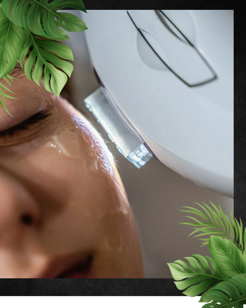 Rosacea IPL