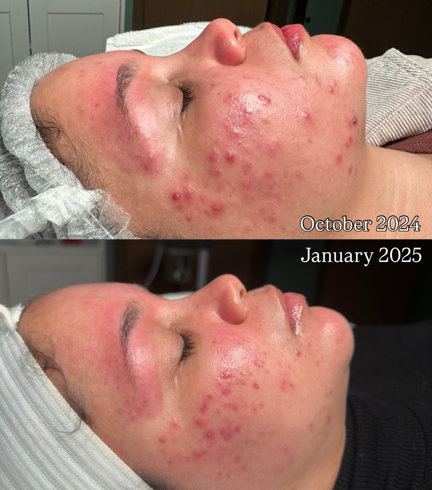 Acne Treatment Facial