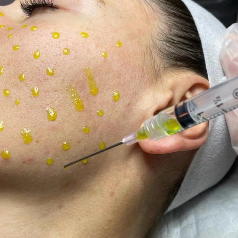 Bio Repeel From Italy at Rejuvené Aesthetics & Wellness in Croton-on-Hudson, NY