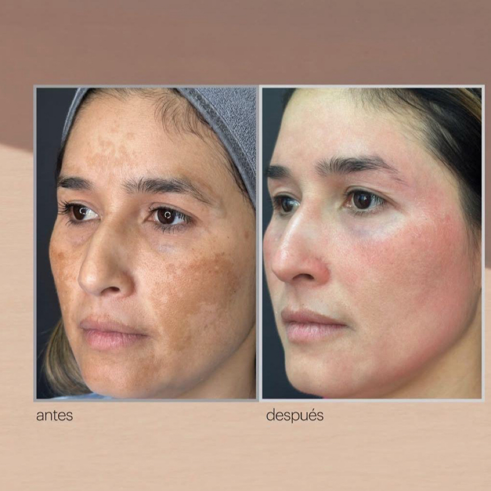 THE MELASMA SIGNATURE RESET  A 12-W at Mily Aesthetics in Newark, NJ