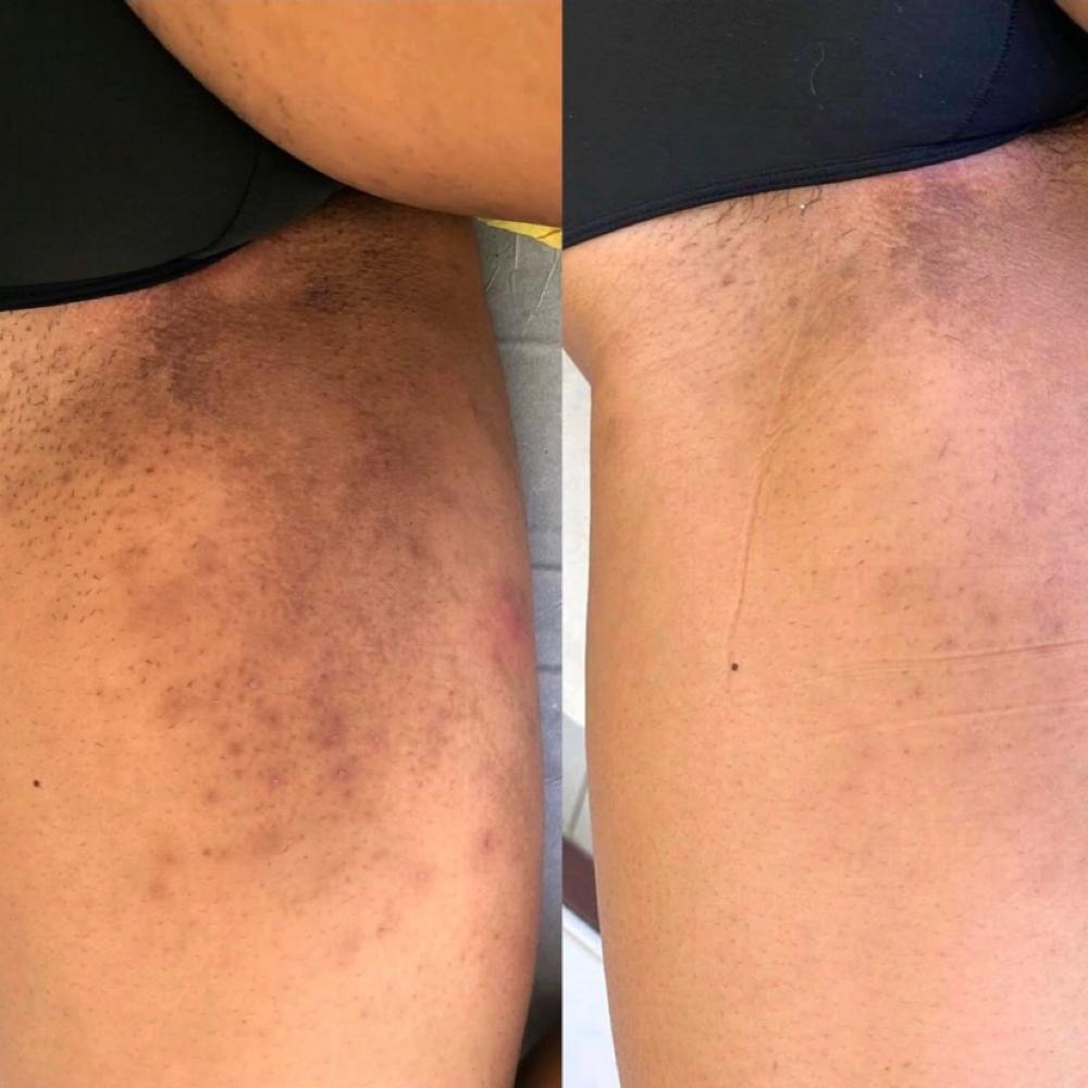 Clareamento Interno De Coxas at Jessica Luchesi Skin Wellness in Elizabeth, NJ