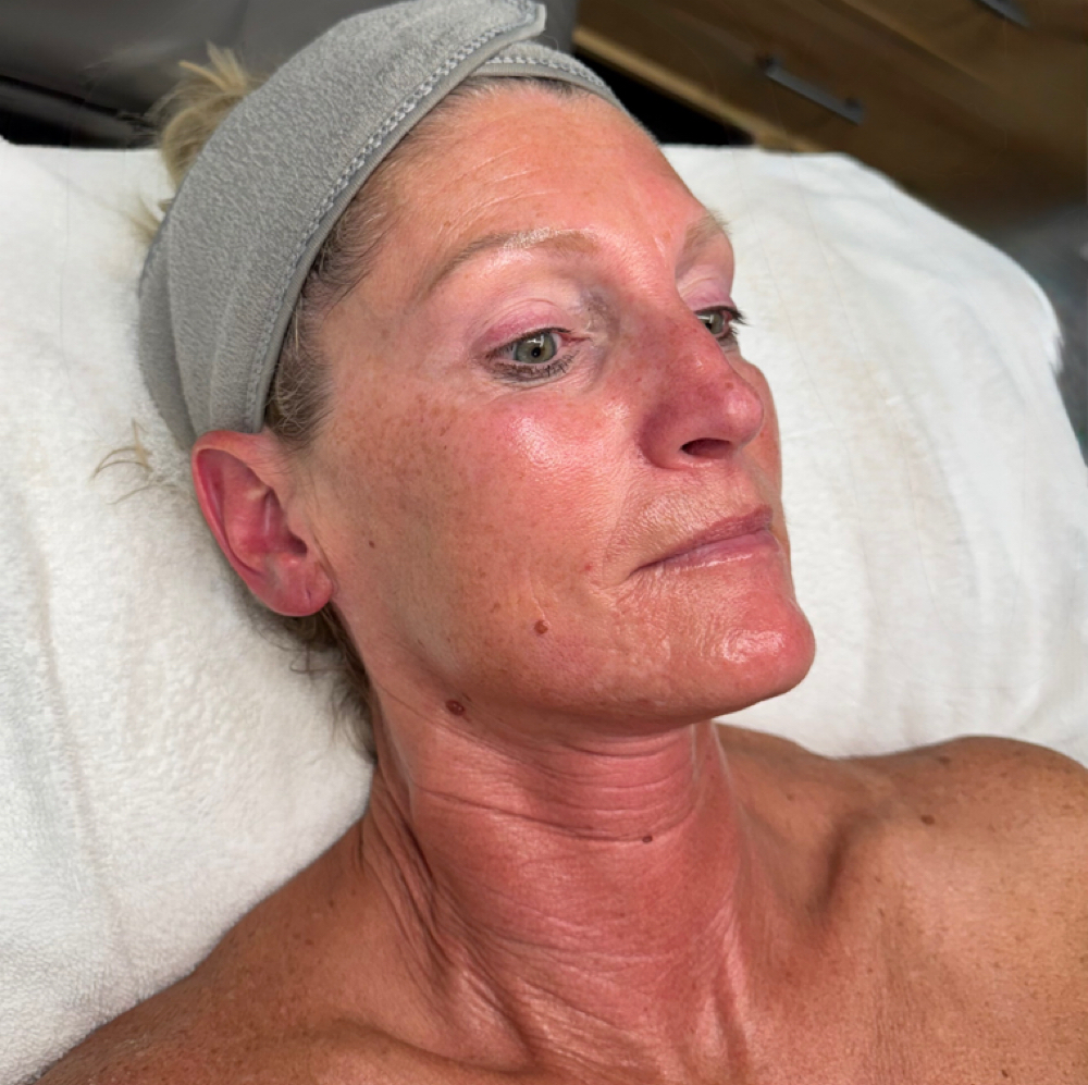 Swich Facial at Lane Luxury Esthetics in Bartlesville, OK