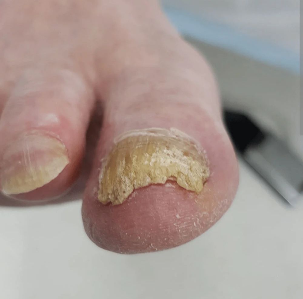 Debridement