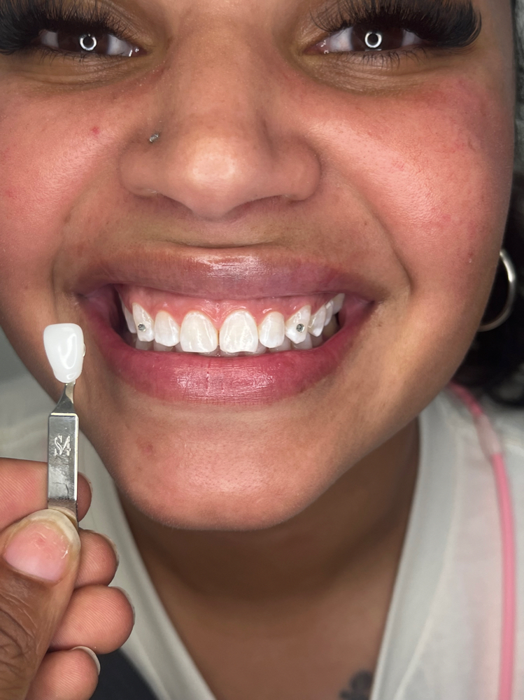 Two Swarvoski/ Preciosa Tooth Gems