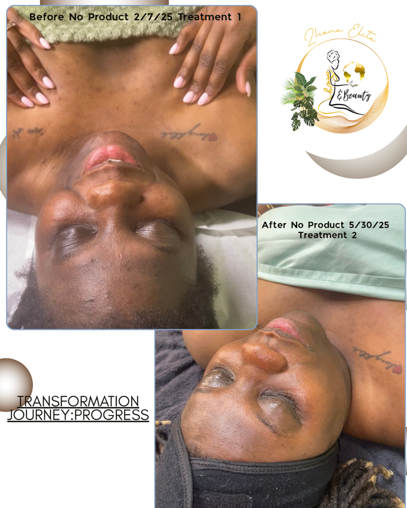 Signature Glow 4 Treatment Series at ZhaneElite Body&beauty in El Cajon, CA